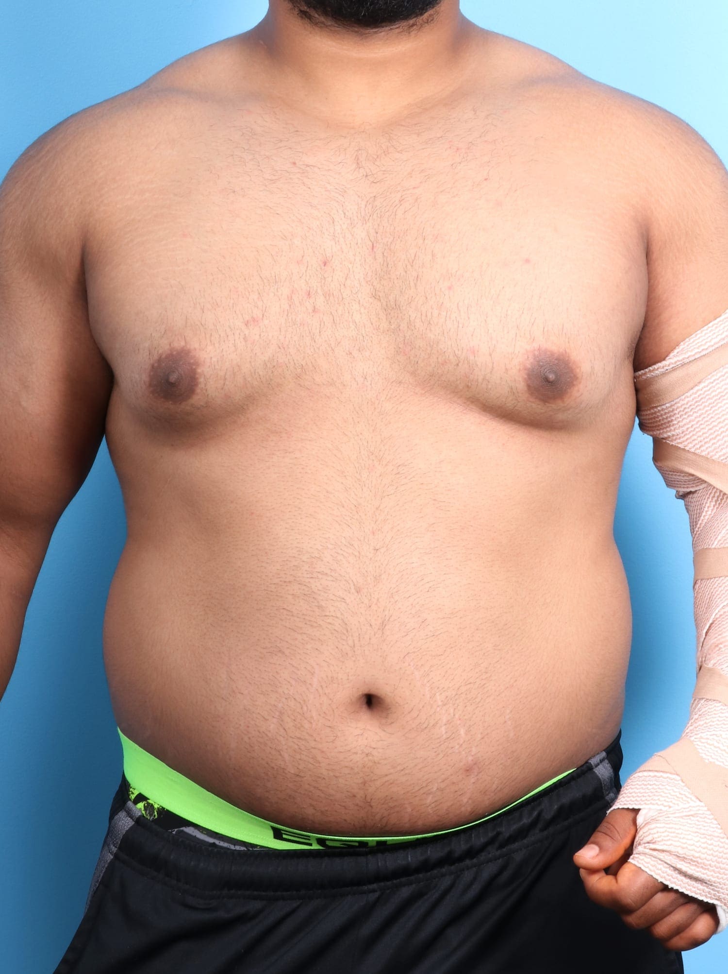 Male Breast Reduction Patient Photo - Case 1684 - before view-0