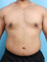 Male Breast Reduction - Case 1684 - After