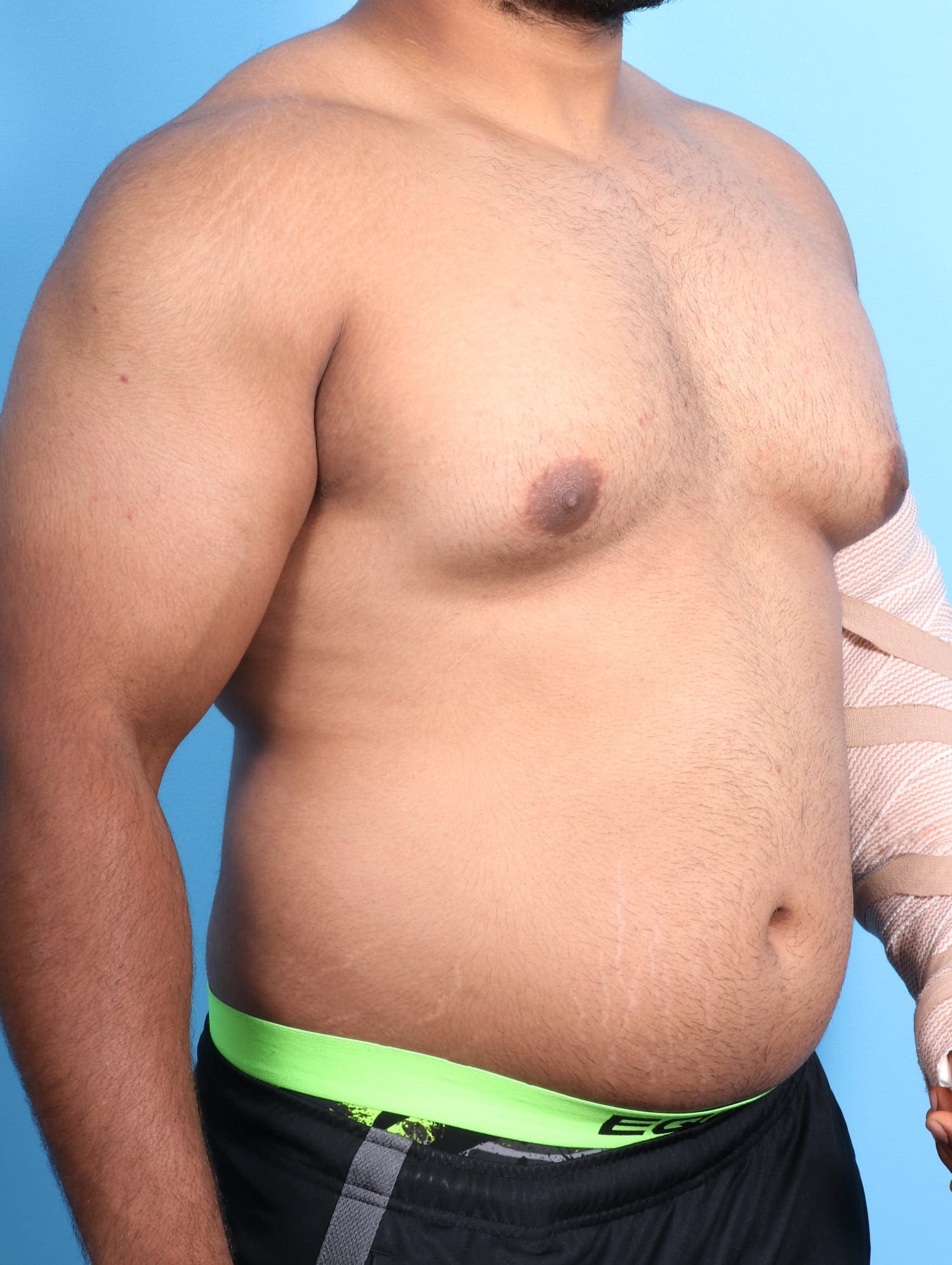 Male Breast Reduction Patient Photo - Case 1684 - before view-2