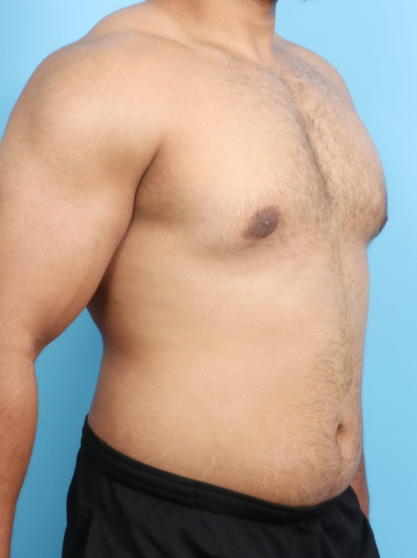 Male Breast Reduction Patient Photo - Case 1684 - after view-2