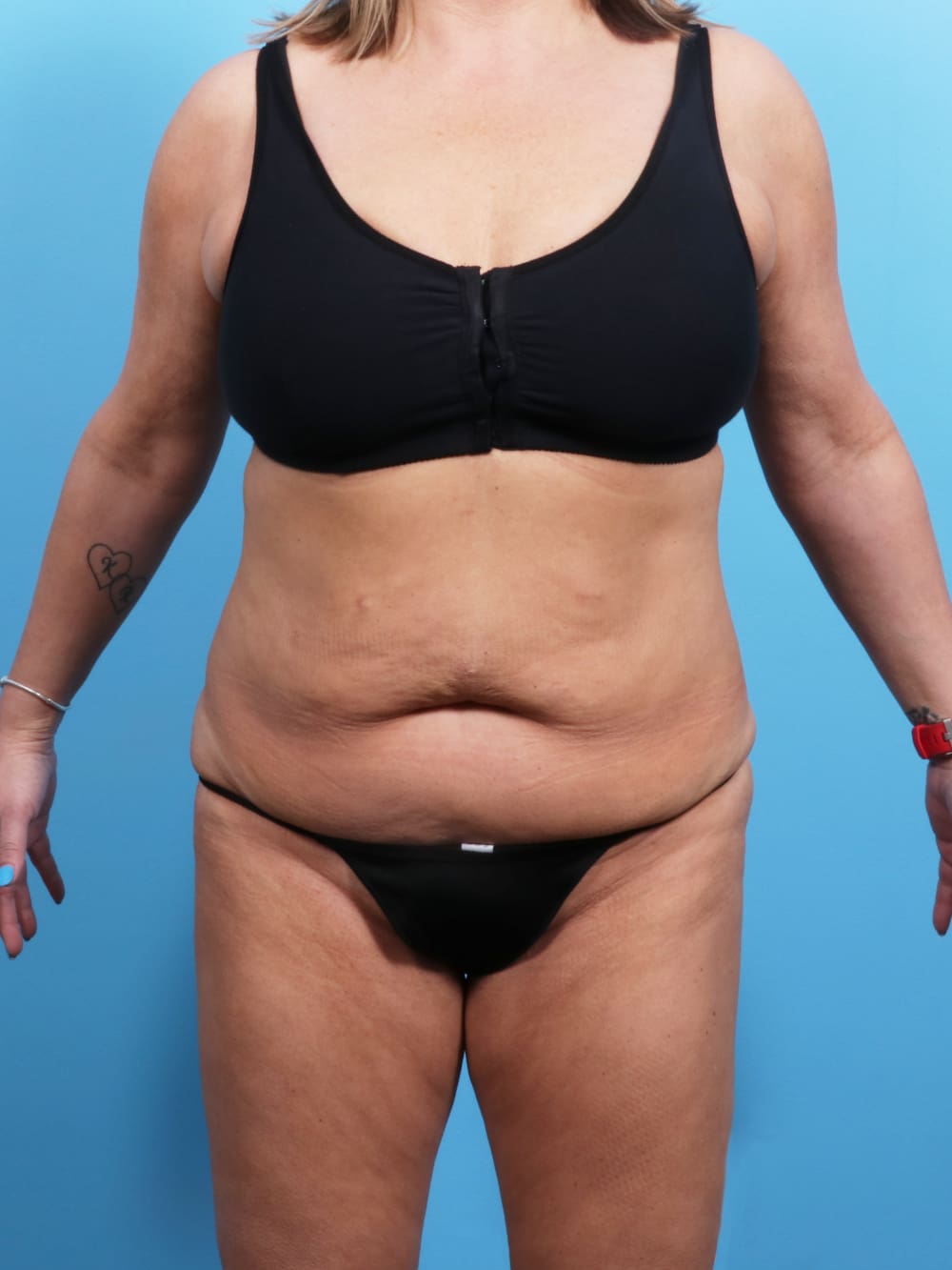 Tummy Tuck Patient Photo - Case 1722 - before view-0