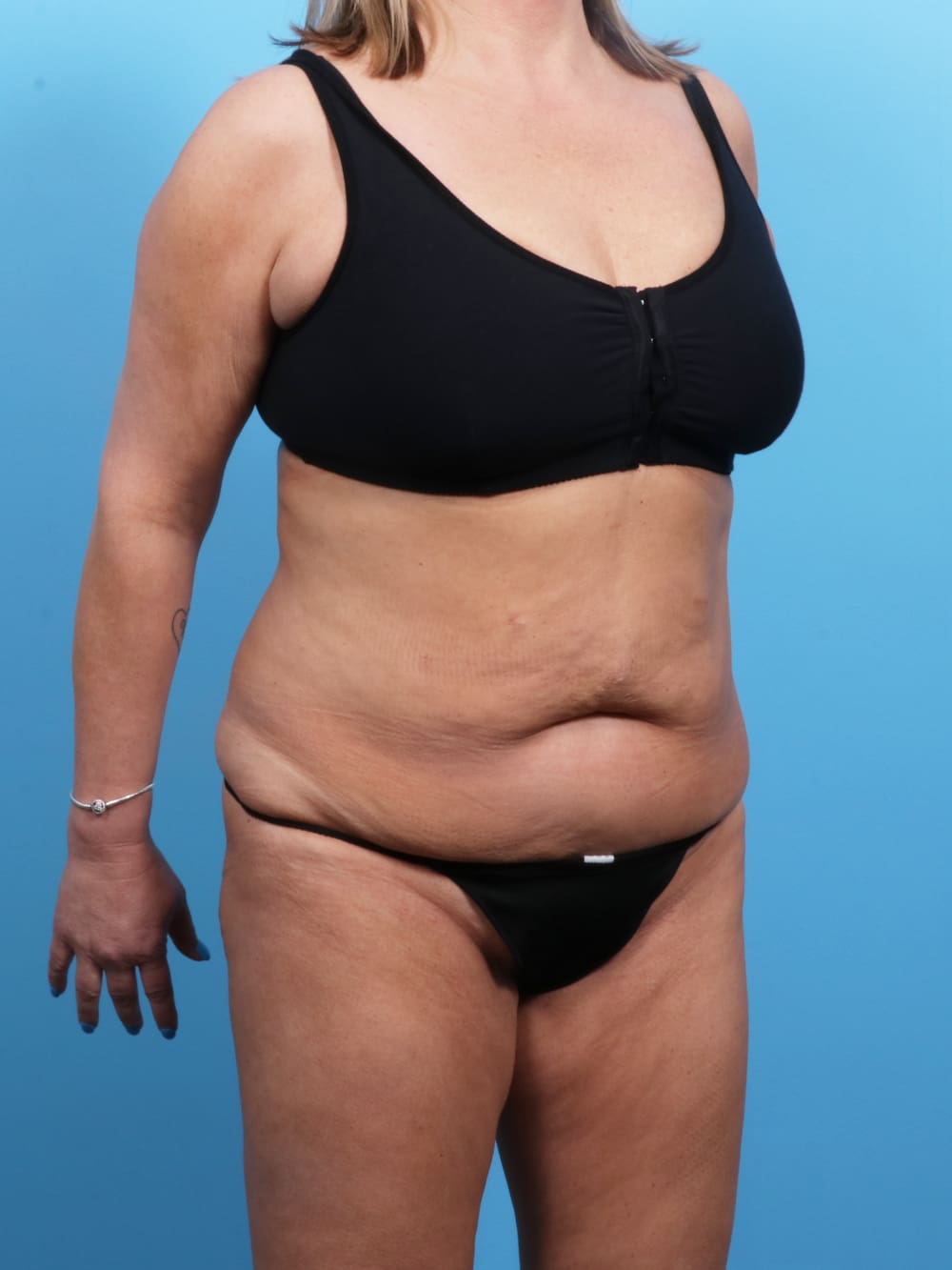 Tummy Tuck Patient Photo - Case 1722 - before view-1
