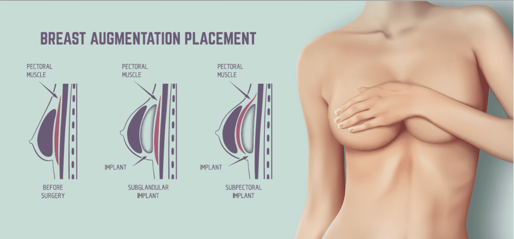 breast augmentation incision points
