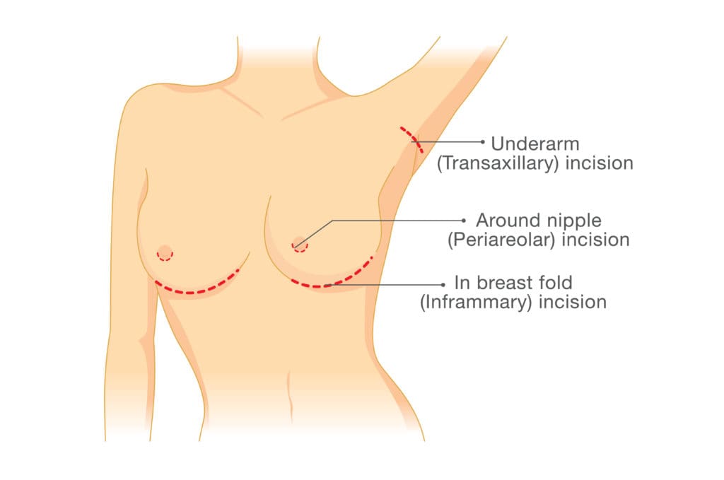Incision points in breast implant surgery. Illustration about cosmetic surgery.