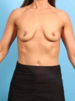 Breast Lift with Implants - Case 1957 - Before
