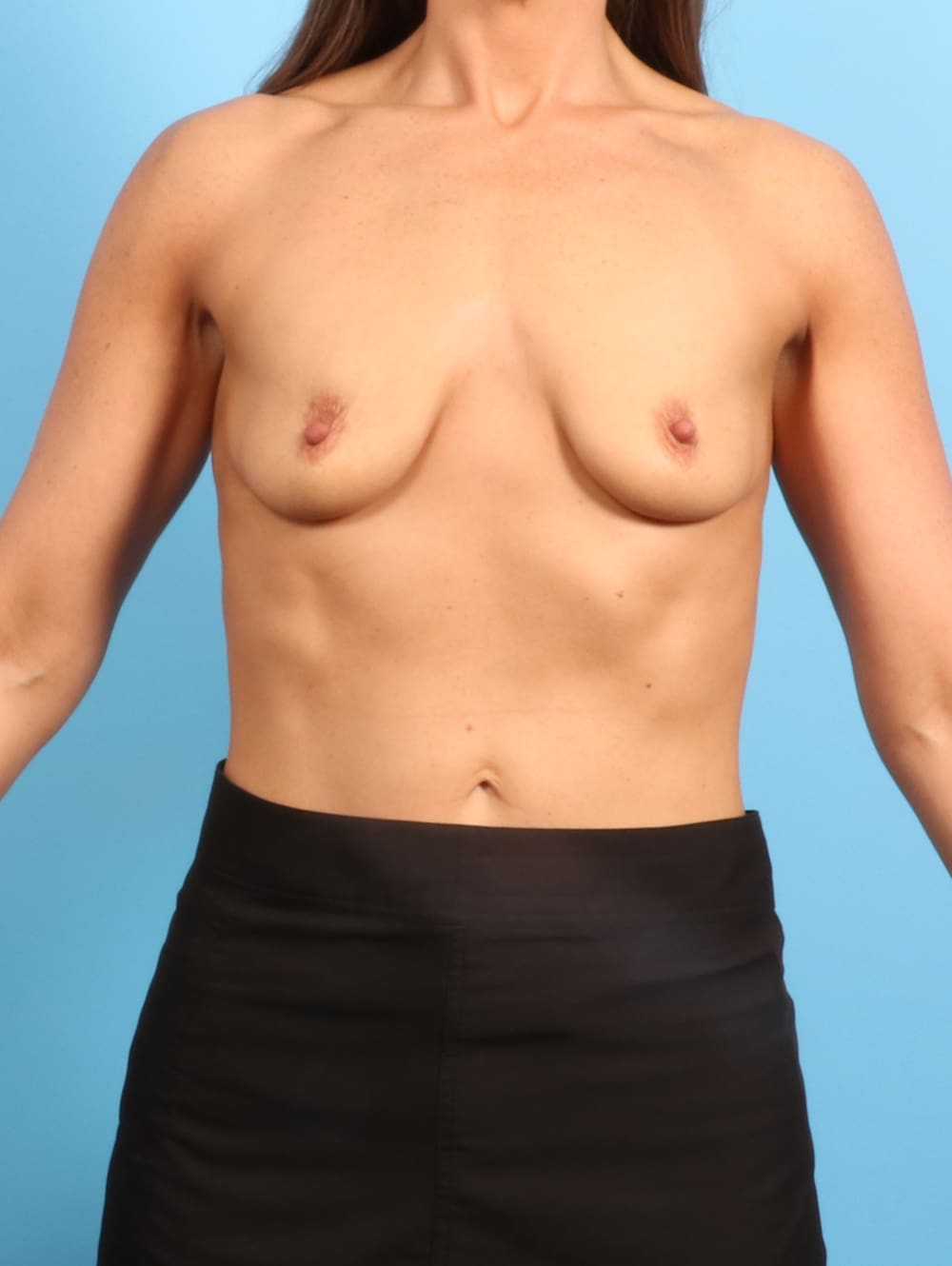 Breast Lift with Implants Patient Photo - Case 1957 - before view-