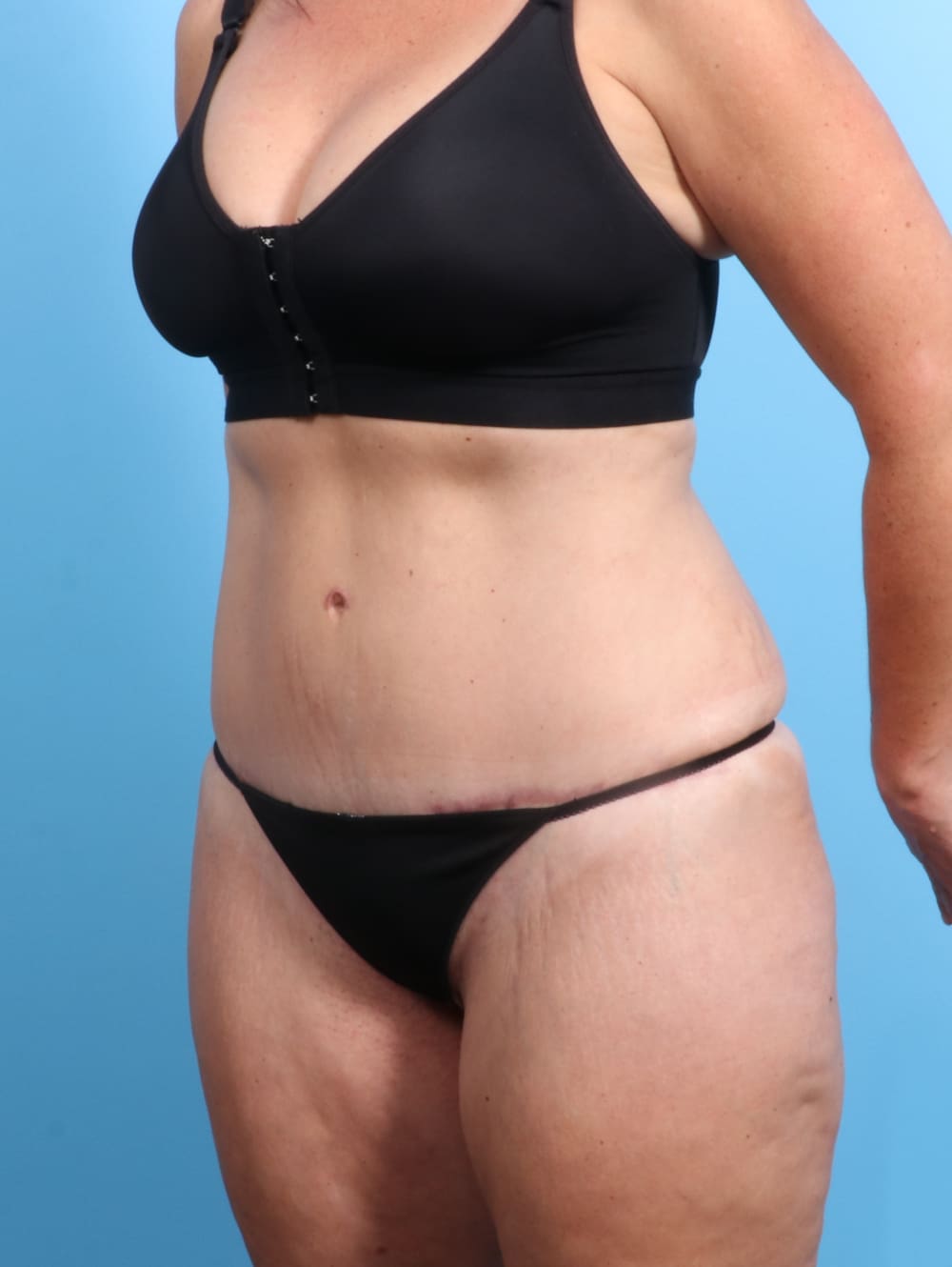 Tummy Tuck Patient Photo - Case 2032 - after view-1