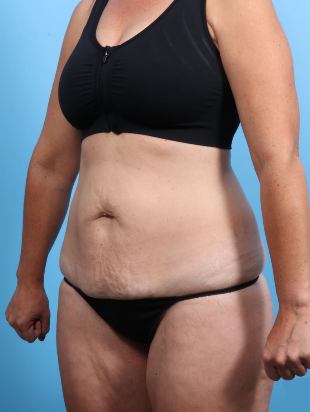 Tummy Tuck Patient Photo - Case 2032 - before view-1