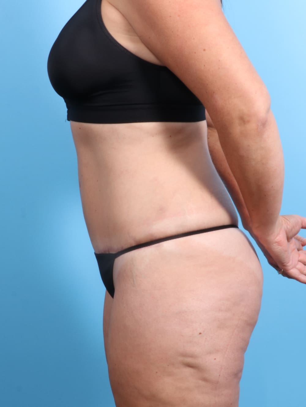 Tummy Tuck Patient Photo - Case 2032 - after view-2