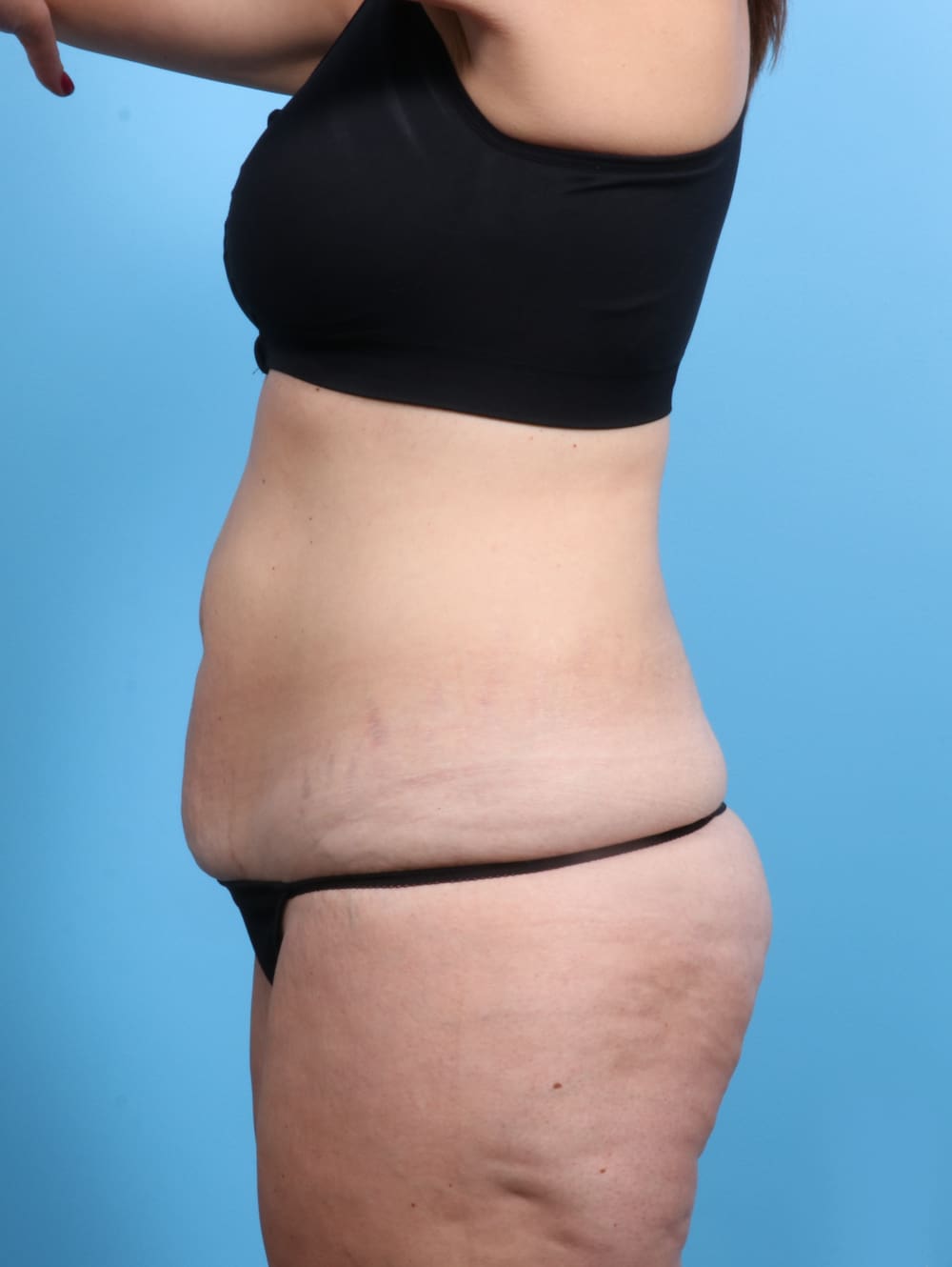 Tummy Tuck Patient Photo - Case 2032 - before view-2