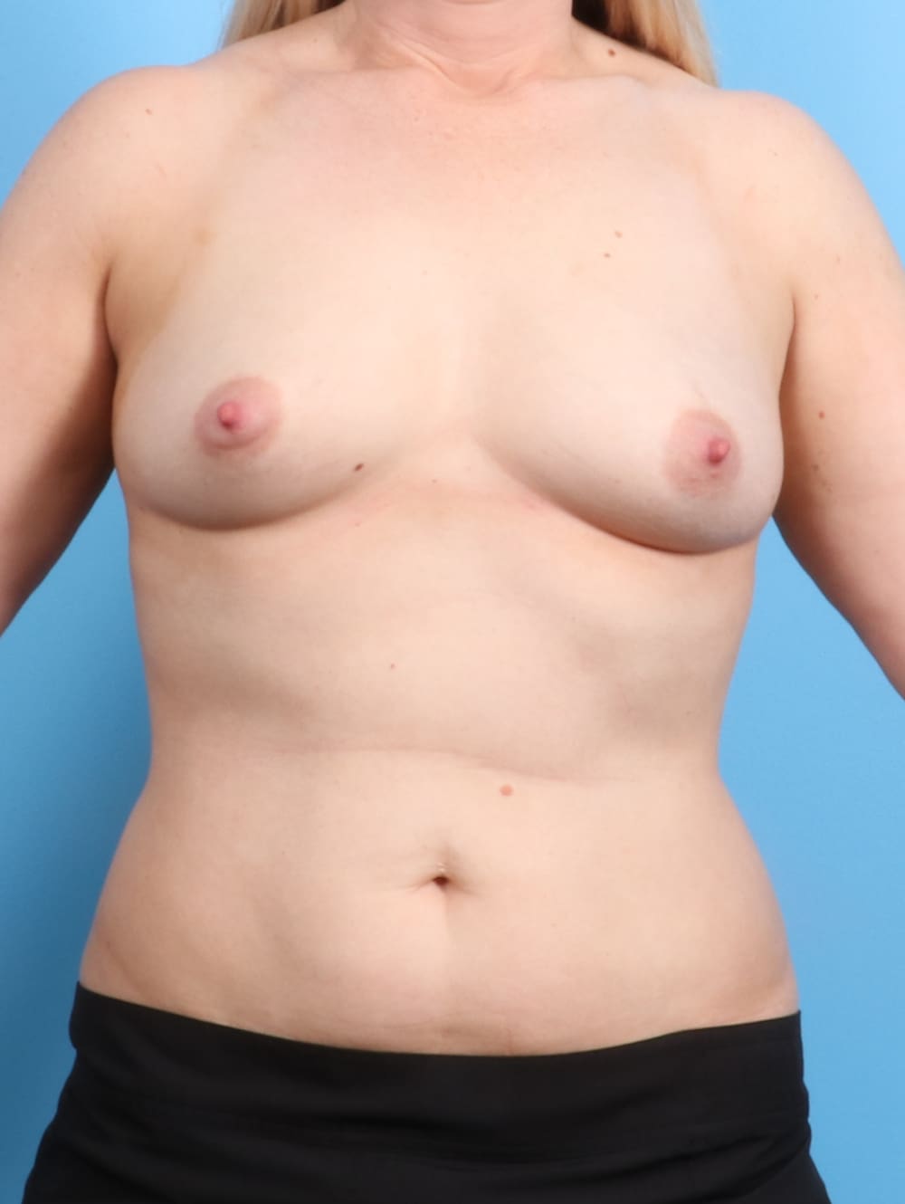 Breast Augmentation Patient Photo - Case 2048 - before view-