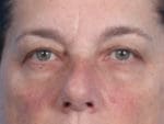 Facial Procedures - Case 2062 - Before