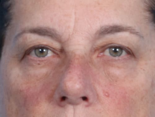 Facial Procedures Patient Photo - Case 2062 - before view-0