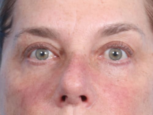 Facial Procedures Patient Photo - Case 2062 - after view