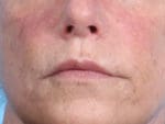 Facial Procedures - Case 2066 - After