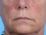 Facial Procedures - Case 2066 - Before