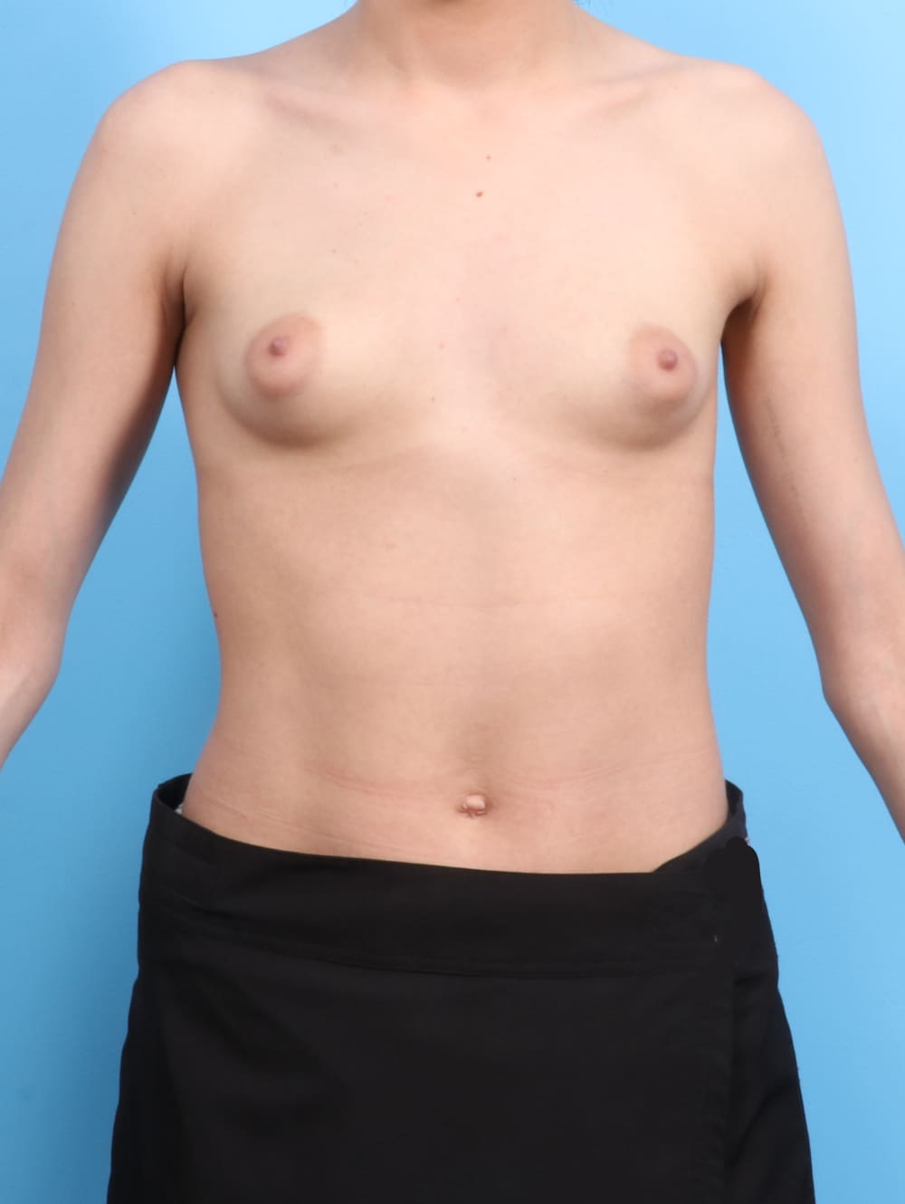 Breast Augmentation Patient Photo - Case 2179 - before view-0
