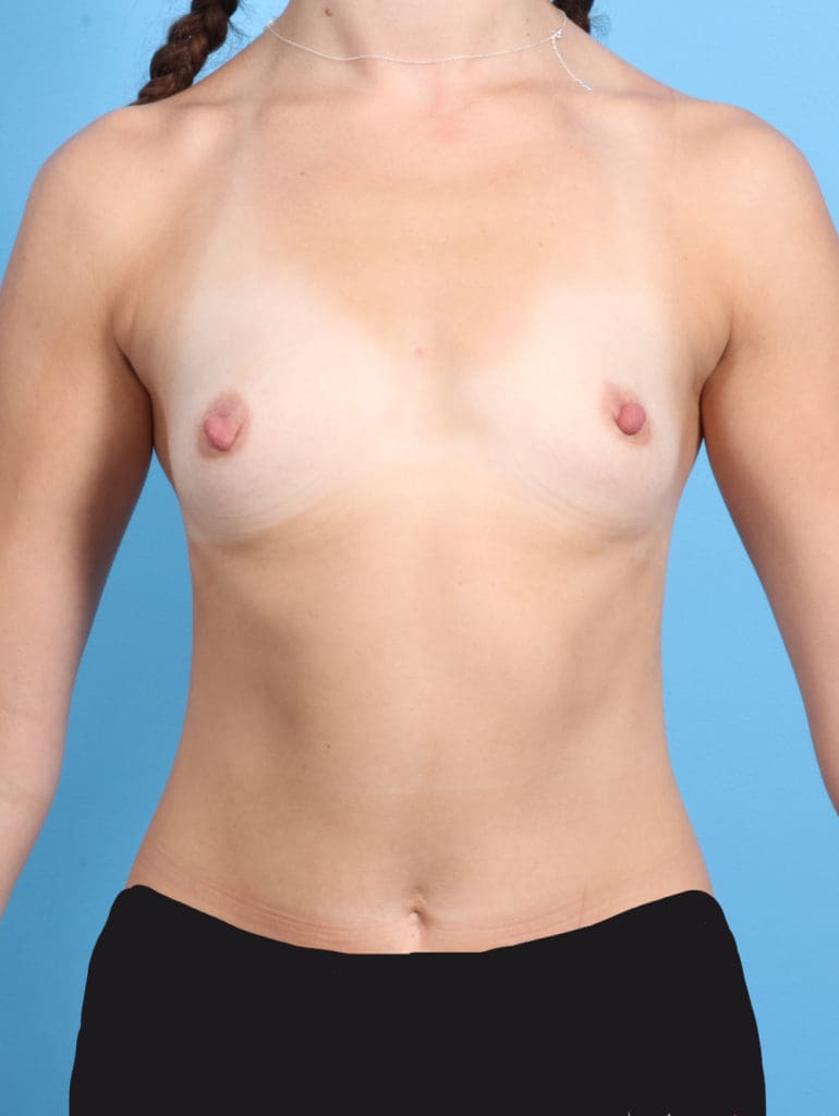 Breast Augmentation - Case 2224 - Before