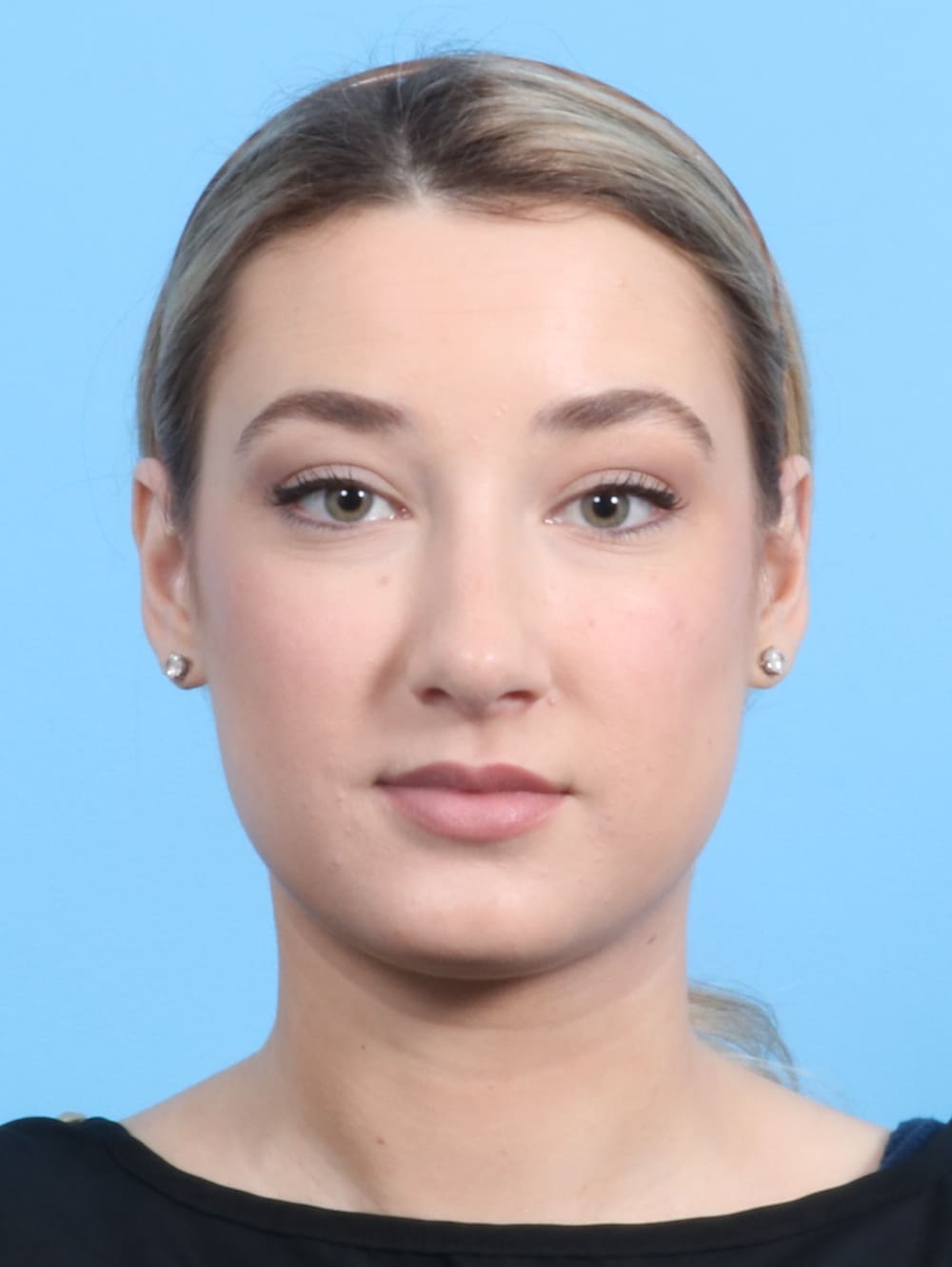 Rhinoplasty Patient Photo - Case 2240 - after view-1