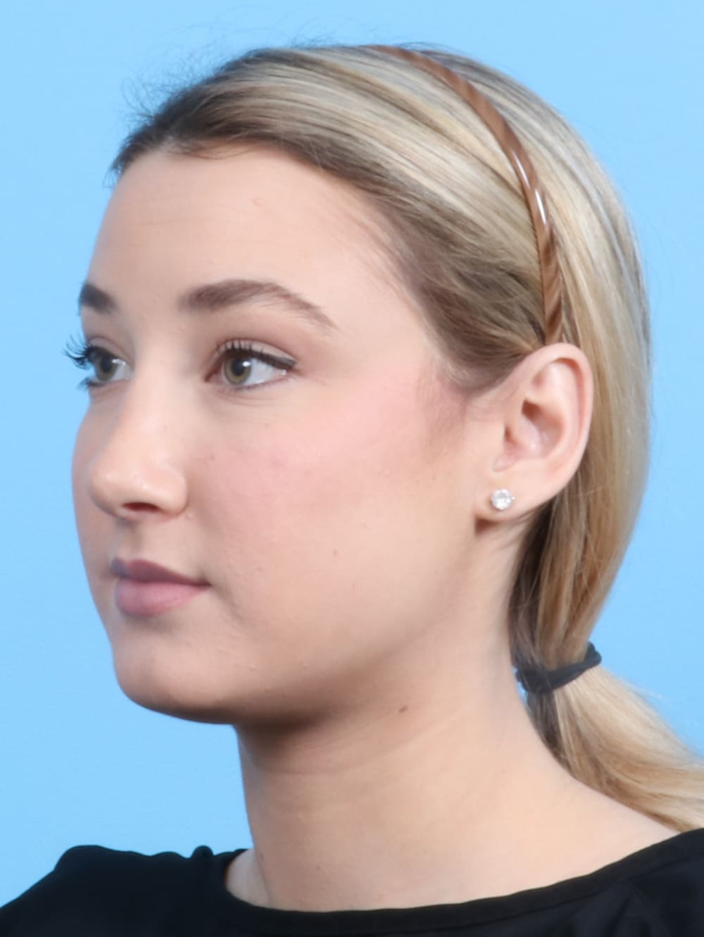 Rhinoplasty Patient Photo - Case 2240 - after view-2