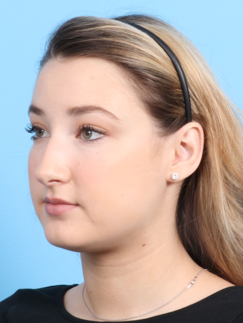 Rhinoplasty Patient Photo - Case 2240 - before view-2
