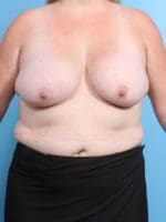 Breast Implant Revision - Case 2274 - Before