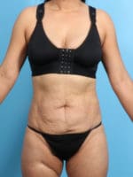 Liposuction - Case 2298 - Before