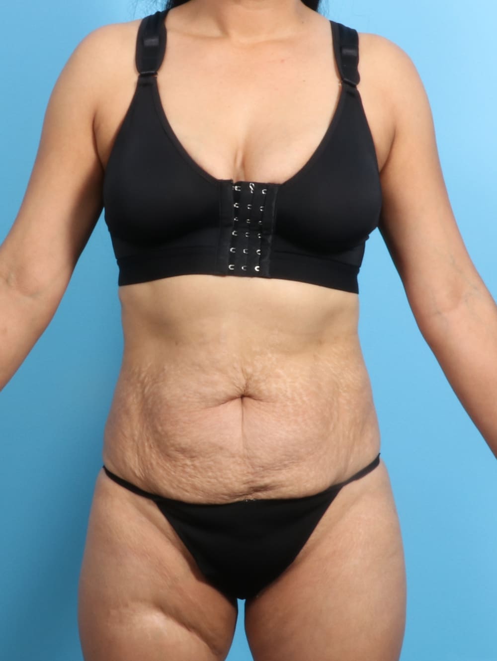 Liposuction Patient Photo - Case 2298 - before view-0