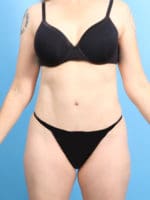 Tummy Tuck - Case 2282 - After