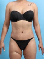 Liposuction - Case 2298 - After