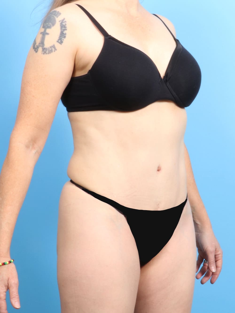 Tummy Tuck Patient Photo - Case 2282 - after view-1
