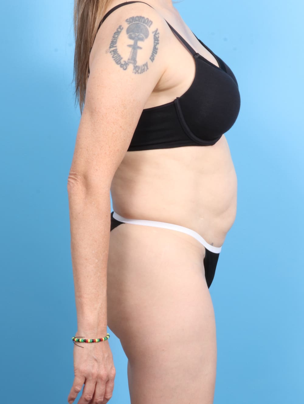 Tummy Tuck Patient Photo - Case 2282 - before view-2