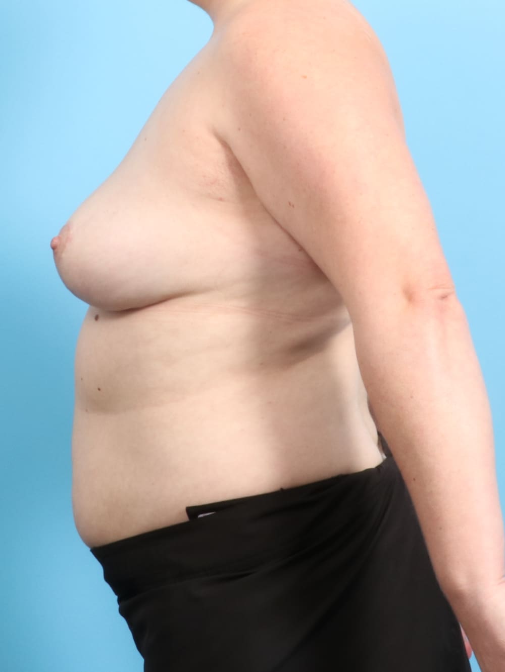 Breast Implant Revision Patient Photo - Case 2274 - after view-2