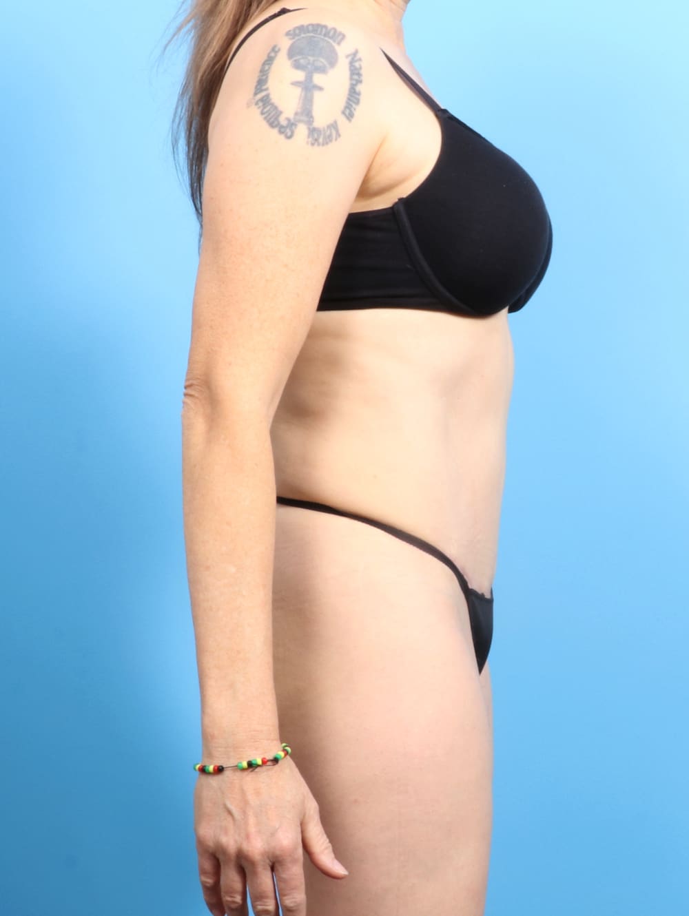 Tummy Tuck Patient Photo - Case 2282 - after view-2