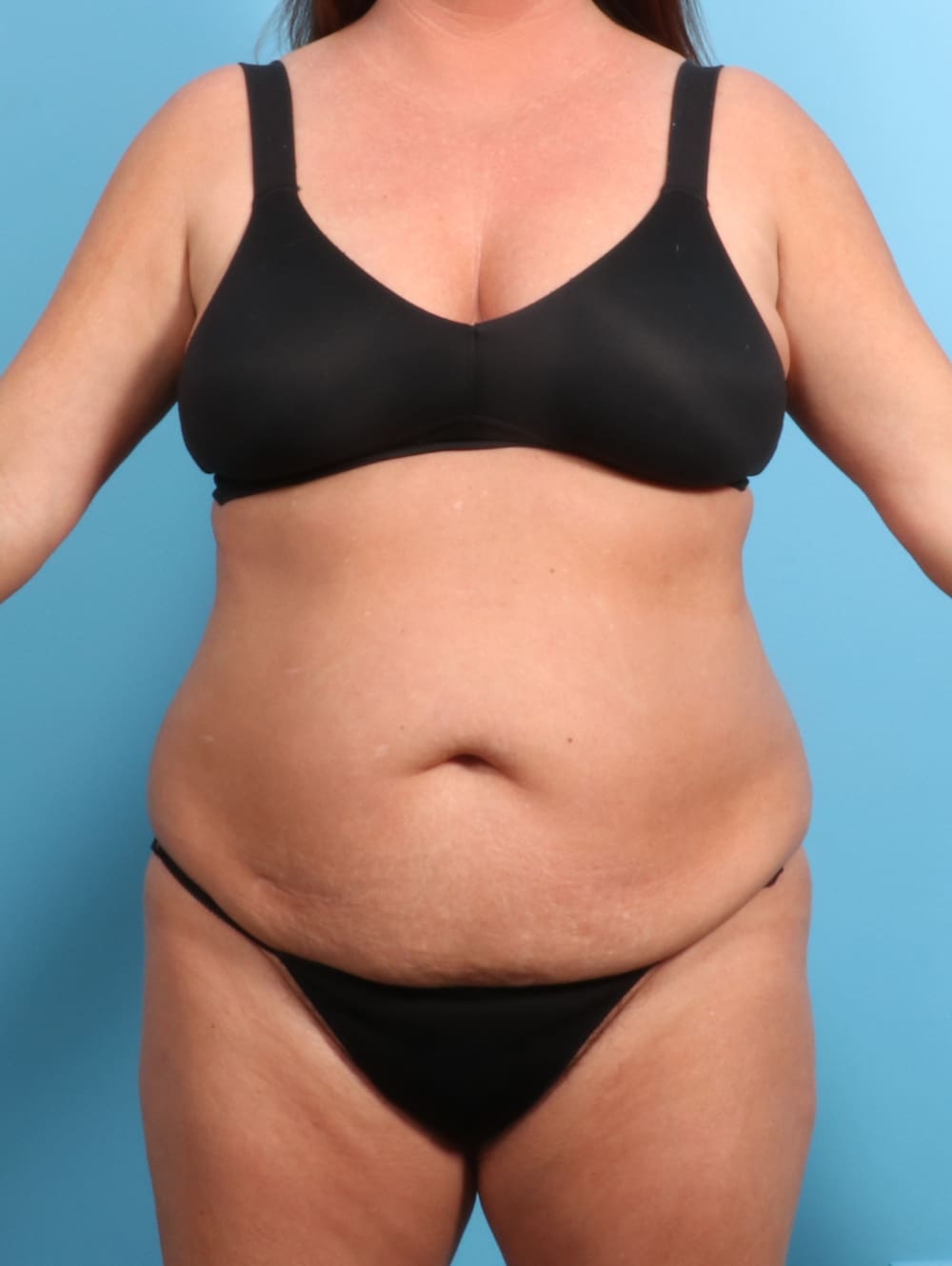 Tummy Tuck Patient Photo - Case 2330 - before view-0