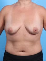 Breast Augmentation - Case 2338 - Before