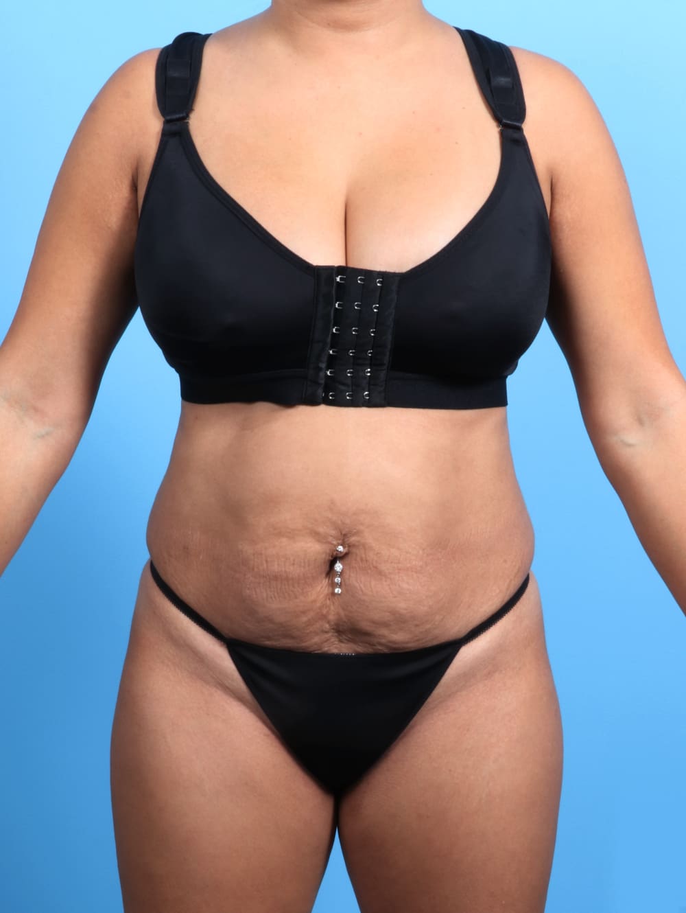 Tummy Tuck Patient Photo - Case 2362 - before view-0