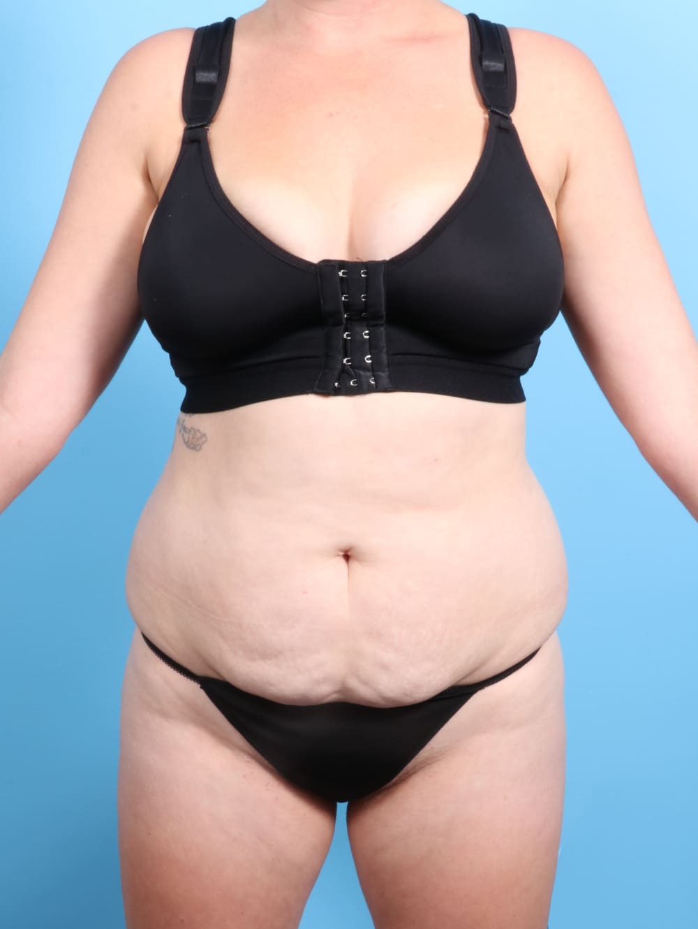 Tummy Tuck Patient Photo - Case 2370 - before view-0