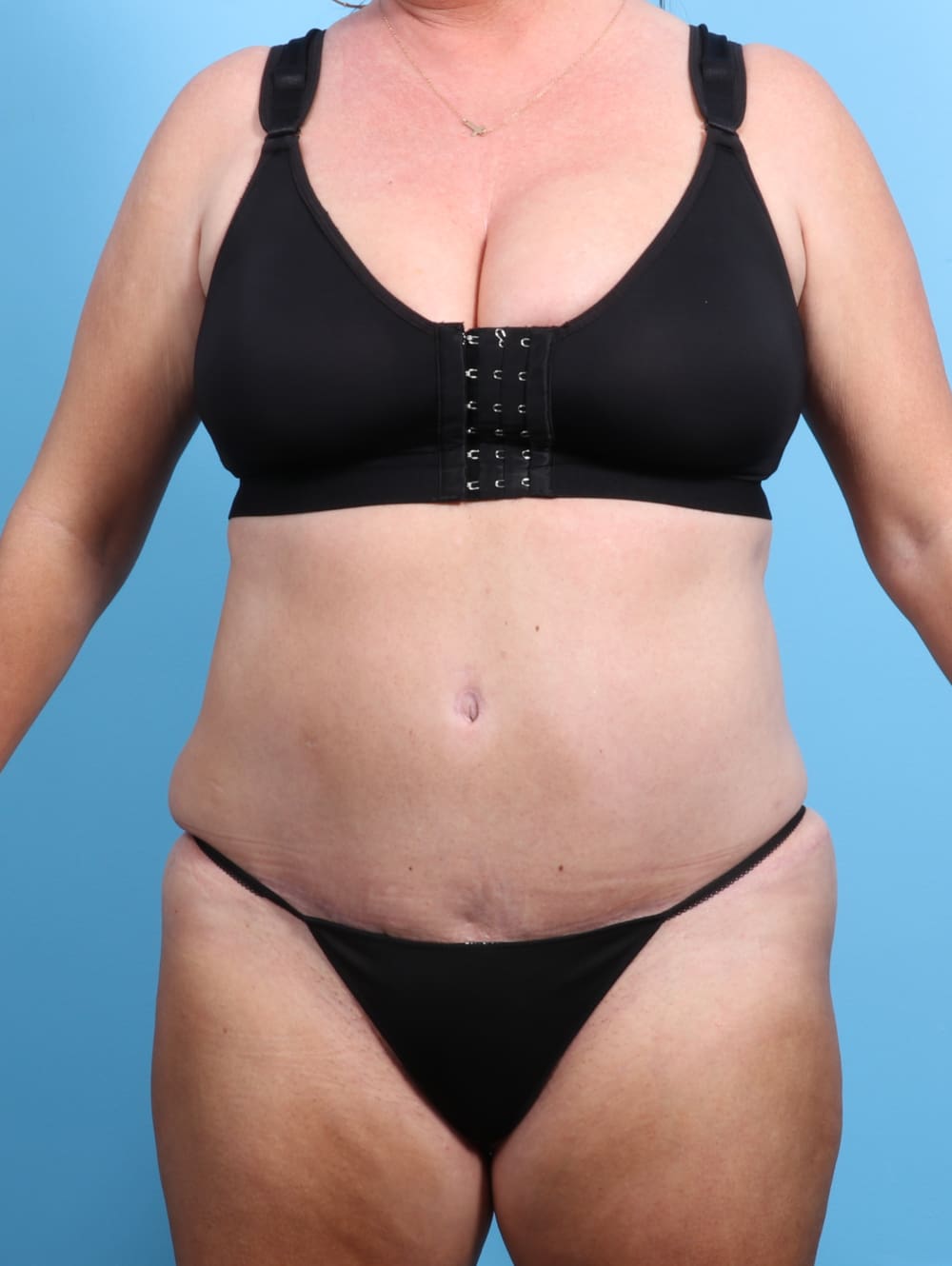 Tummy Tuck Patient Photo - Case 2330 - after view-0