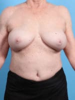 Breast Implant Revision - Case 2346 - After