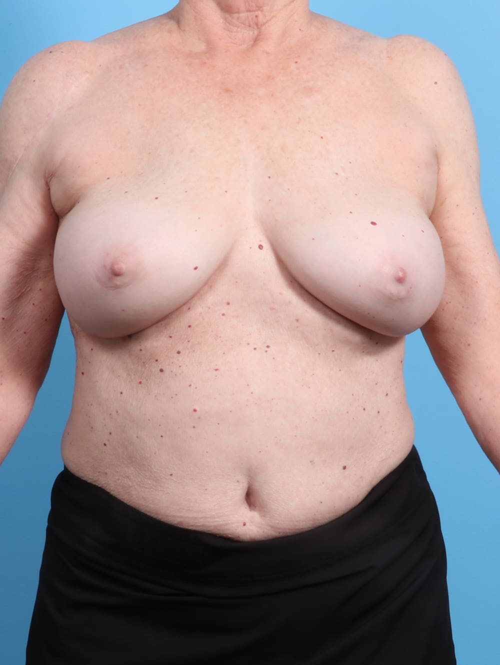 Breast Implant Revision Patient Photo - Case 2346 - after view