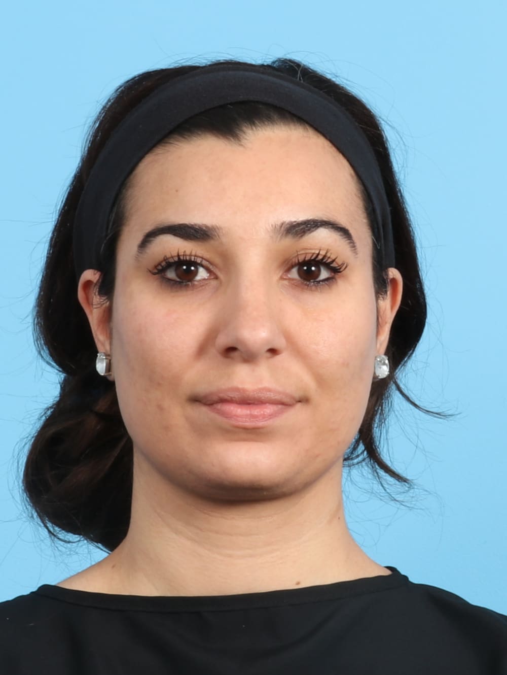 Rhinoplasty Patient Photo - Case 2354 - after view-1