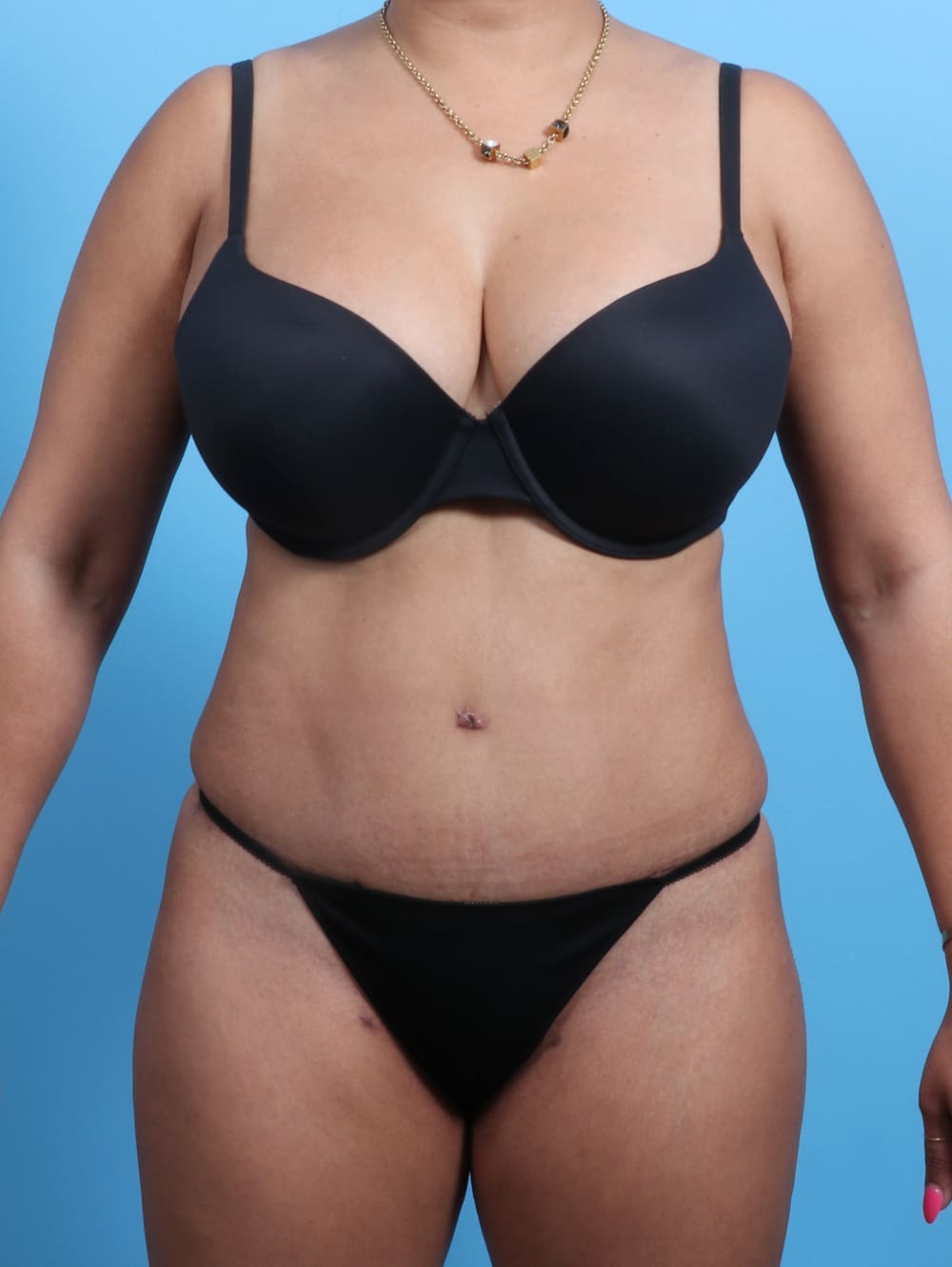 Tummy Tuck Patient Photo - Case 2362 - after view-0