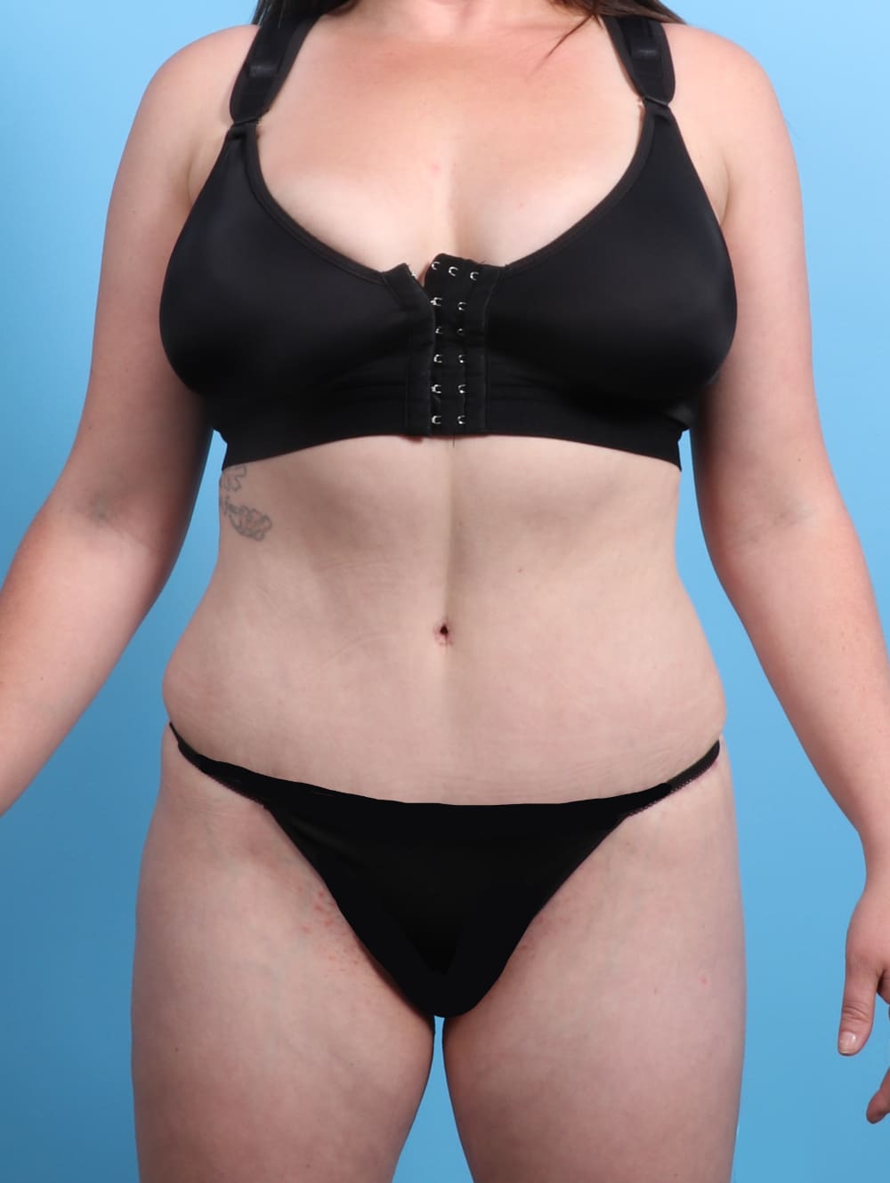 Tummy Tuck Patient Photo - Case 2370 - after view
