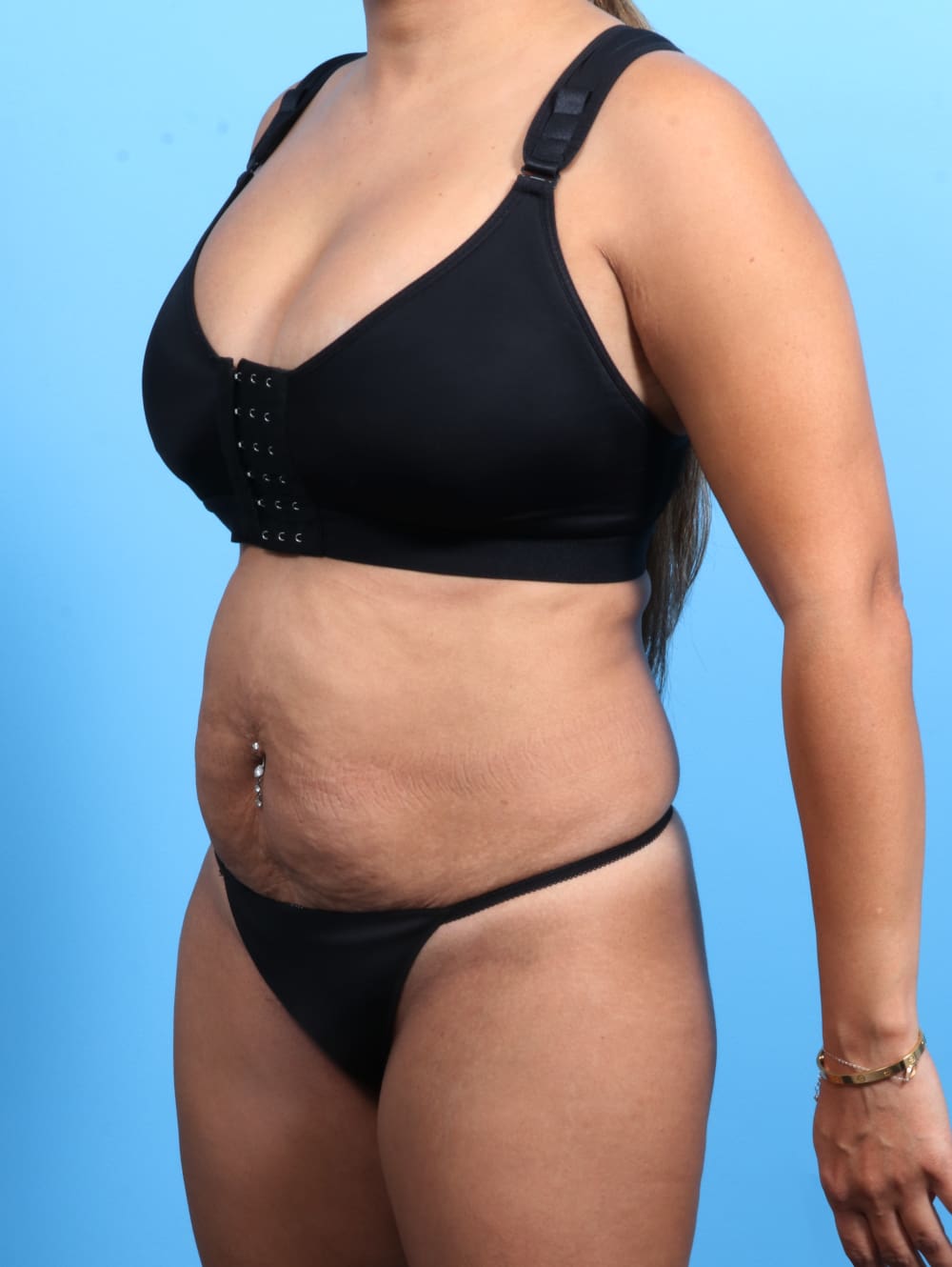 Tummy Tuck Patient Photo - Case 2362 - before view-1
