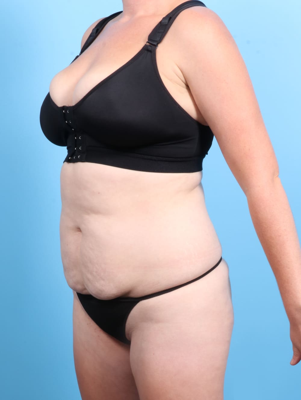 Tummy Tuck Patient Photo - Case 2370 - before view-1