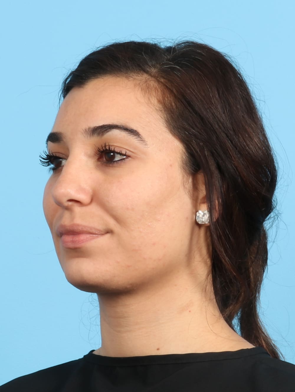 Rhinoplasty Patient Photo - Case 2354 - after view-2