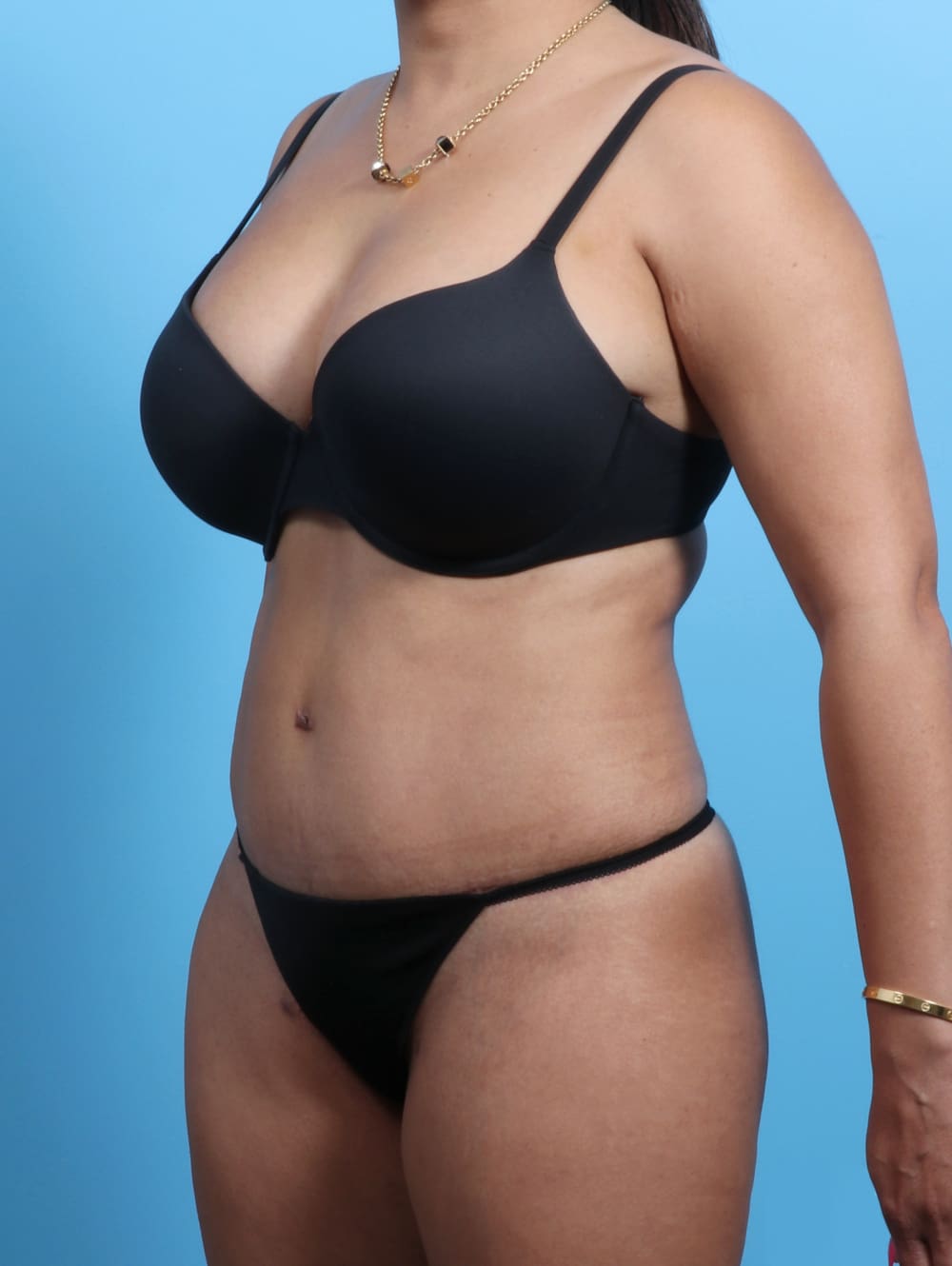 Tummy Tuck Patient Photo - Case 2362 - after view-1