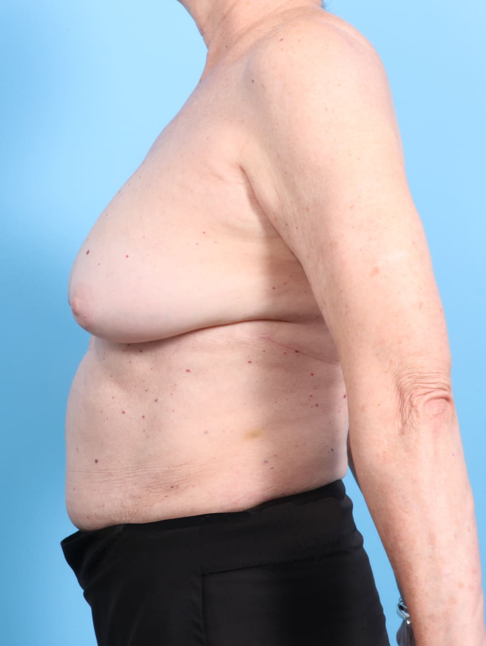 Breast Implant Revision Patient Photo - Case 2346 - before view-2