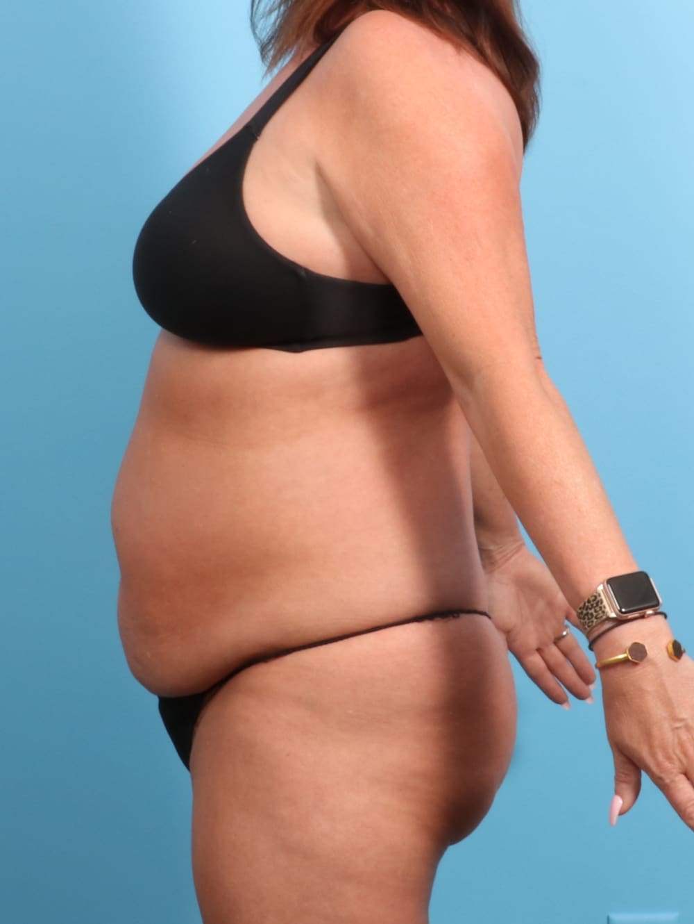 Tummy Tuck Patient Photo - Case 2330 - before view-2